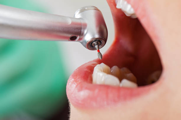 Best Emergency Tooth Extraction in Bonadelle Ranchos, CA